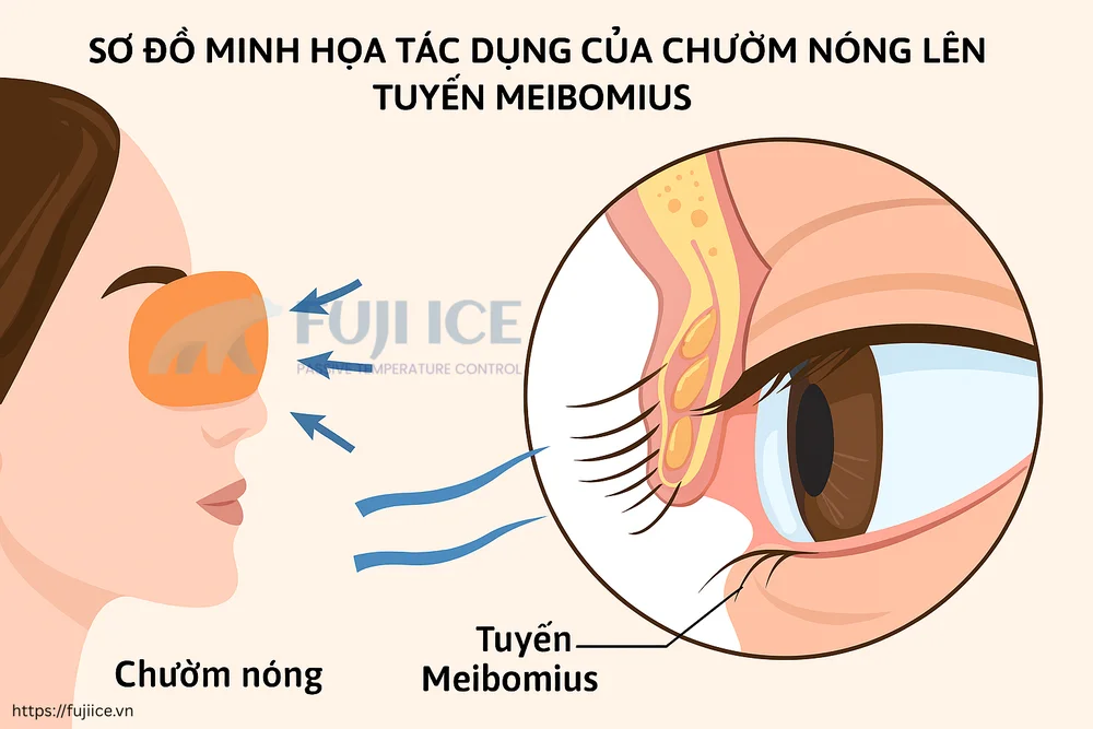 Tác dụng của chườm nóng lên tuyến Meibomius của mắt